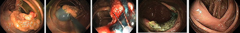 EMR colon polyp removal photo sequence