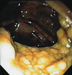 Large flat villous adenoma colon polyp