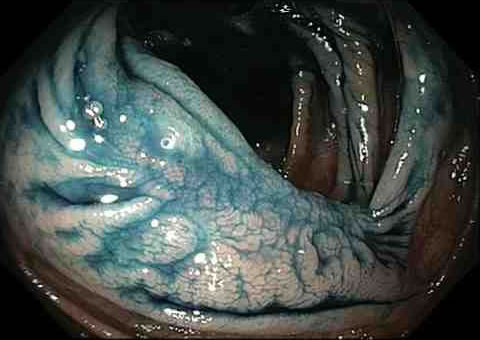 Post EMR polyp site white light blue dye